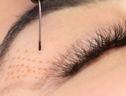Blefaroplexer: il trattamento non chirurgico per ringiovanire lo sguardo